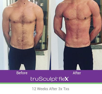 trusculpt singapore|truSculpt® Overview: Cost, Recovery, Before & After .